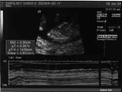 Sonogram 1/8/04.