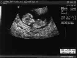 Sonogram 1/8/04.