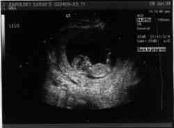 Sonogram 1/8/04.