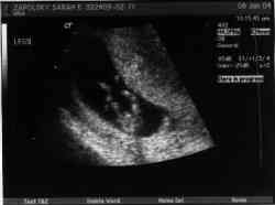 Sonogram 1/8/04.