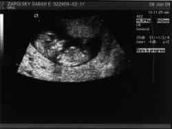 Sonogram 1/8/04.