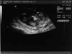 Sonogram 1/8/04.