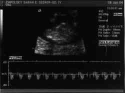 Sonogram 1/8/04.