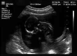 Sonogram 2/2/04.